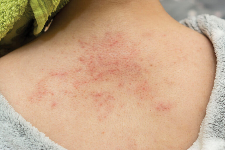 Rashes from kidney disease