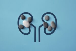 Kidney stones