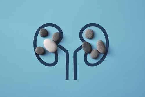 Kidney stones