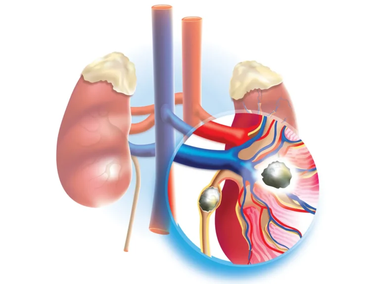 Common Kidney Disorders Explained: Kidney Stones, Infections, and Acute Kidney Injury
